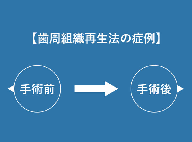 歯周組織再生法の症例 手術前 手術後